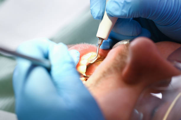Best Emergency Root Canal Treatment in Baraga, MI